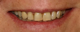 CEREC AC OMNICAM ПРОСТОЕ СКАНИРОВАНИЕ БЕЗ АНТИБЛИКОВОГО СПРЕЯ 26.jpg